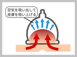 カッピングは腰痛に効果があるのでしょうか?